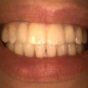 Haws Family Dentistry smile makeover after — Brigham City, UT