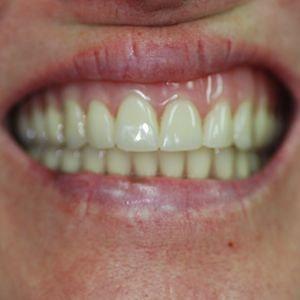 Haws Family Dentistry smile makeover after — Brigham City, UT