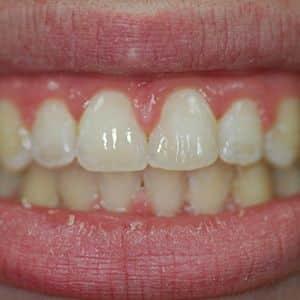 Haws Family Dentistry smile makeover after — Brigham City, UT