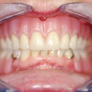 Haws Family Dentistry smile makeover after — Brigham City, UT