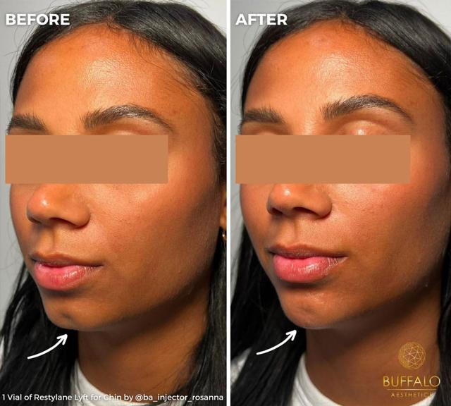 Jawline Filler result at Buffalo Aesthetics | The Medical Spa Experts in East Amherst, NY