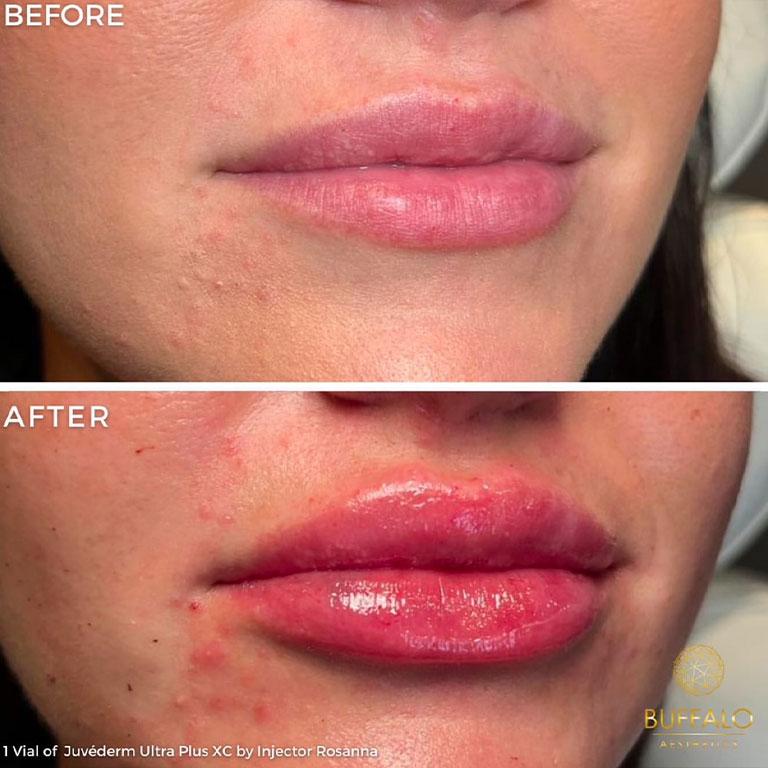 Buffalo Aesthetics | The Medical Spa Experts lip filler after — East Amherst, NY