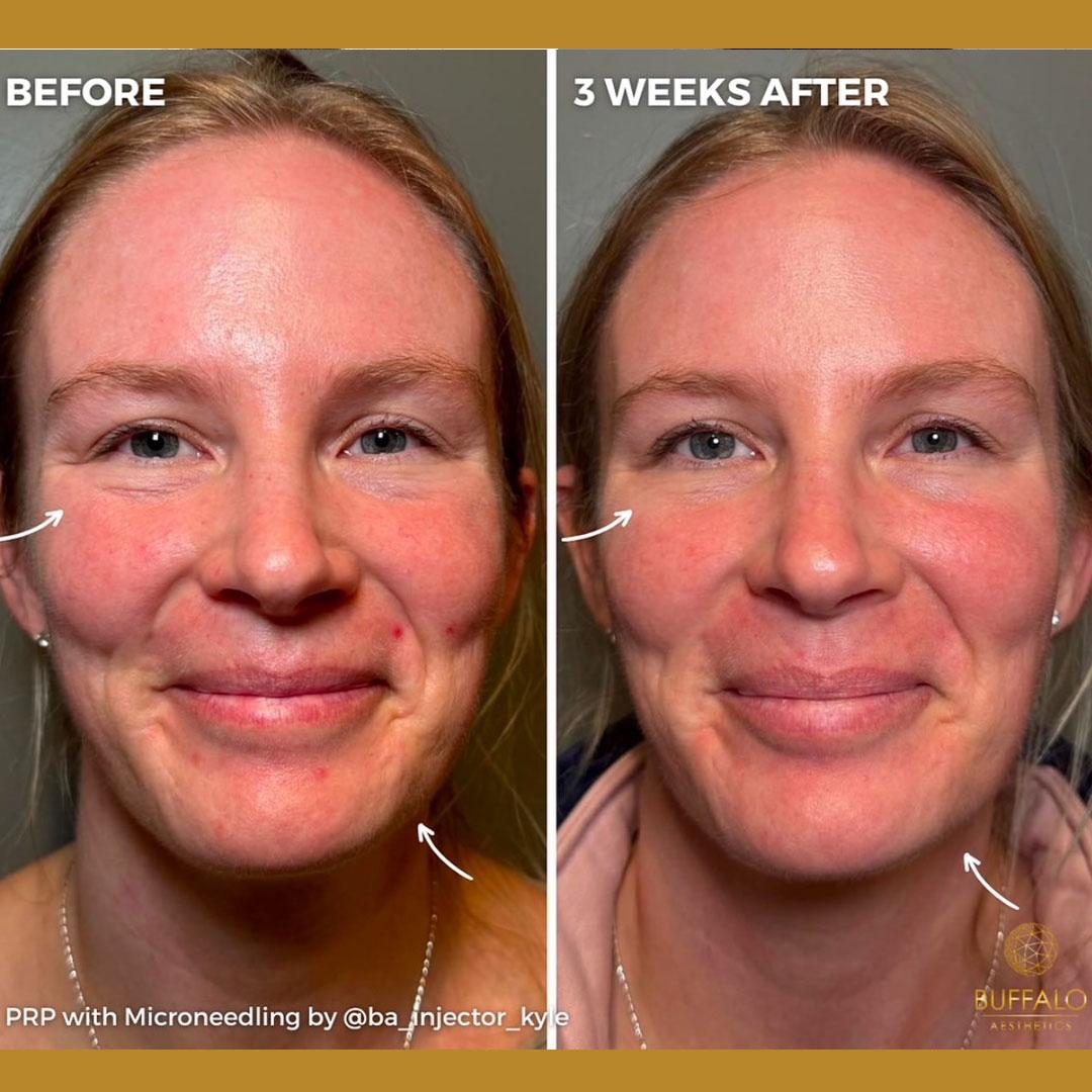 Buffalo Aesthetics | The Medical Spa Experts microneedling after — East Amherst, NY