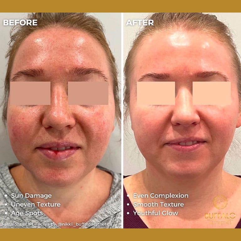Buffalo Aesthetics | The Medical Spa Experts laser treatment after — East Amherst, NY