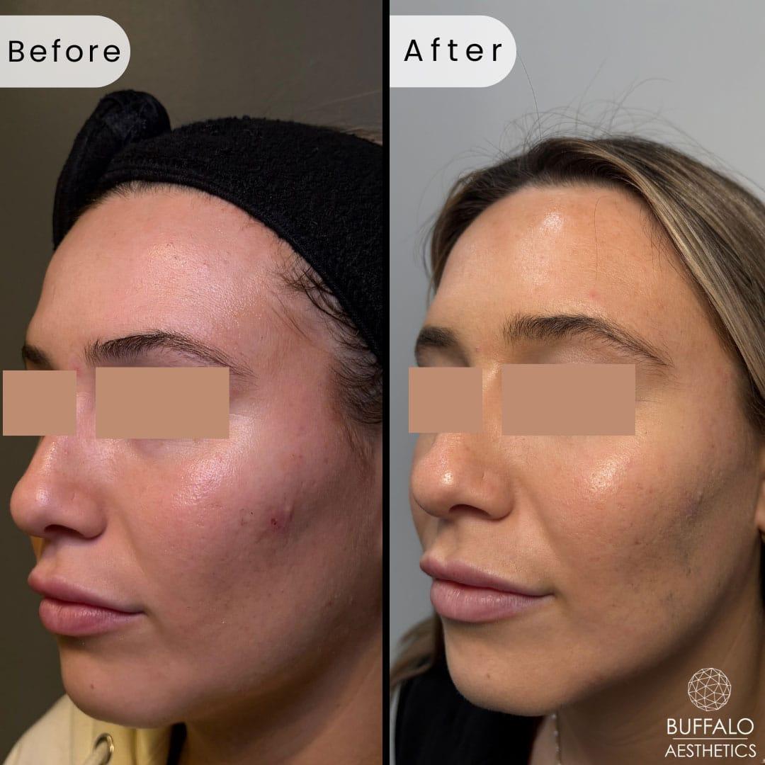 Buffalo Aesthetics | The Medical Spa Experts microneedling result — East Amherst, NY