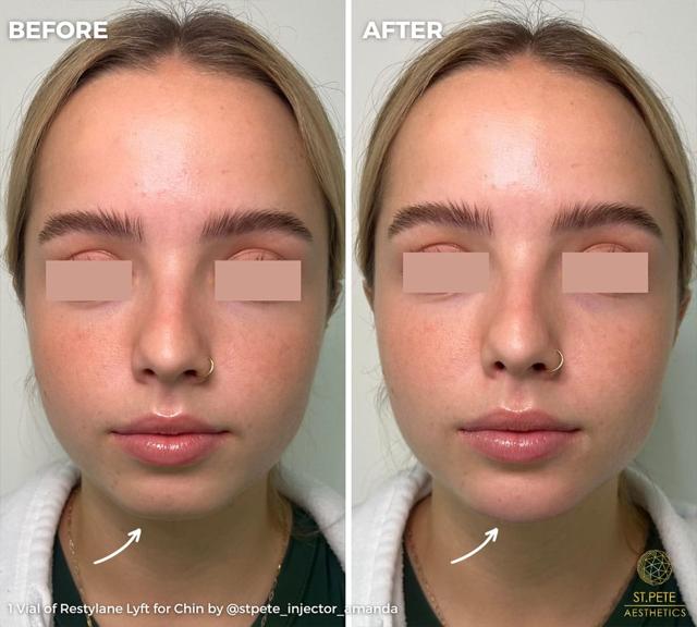Jawline Filler result at Buffalo Aesthetics | The Medical Spa Experts in East Amherst, NY
