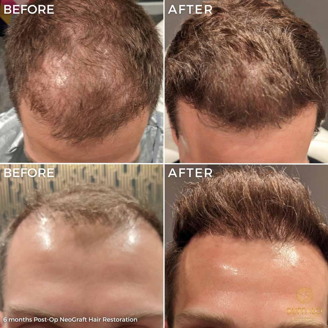 Buffalo Aesthetics | The Medical Spa Experts hair restoration result — East Amherst, NY