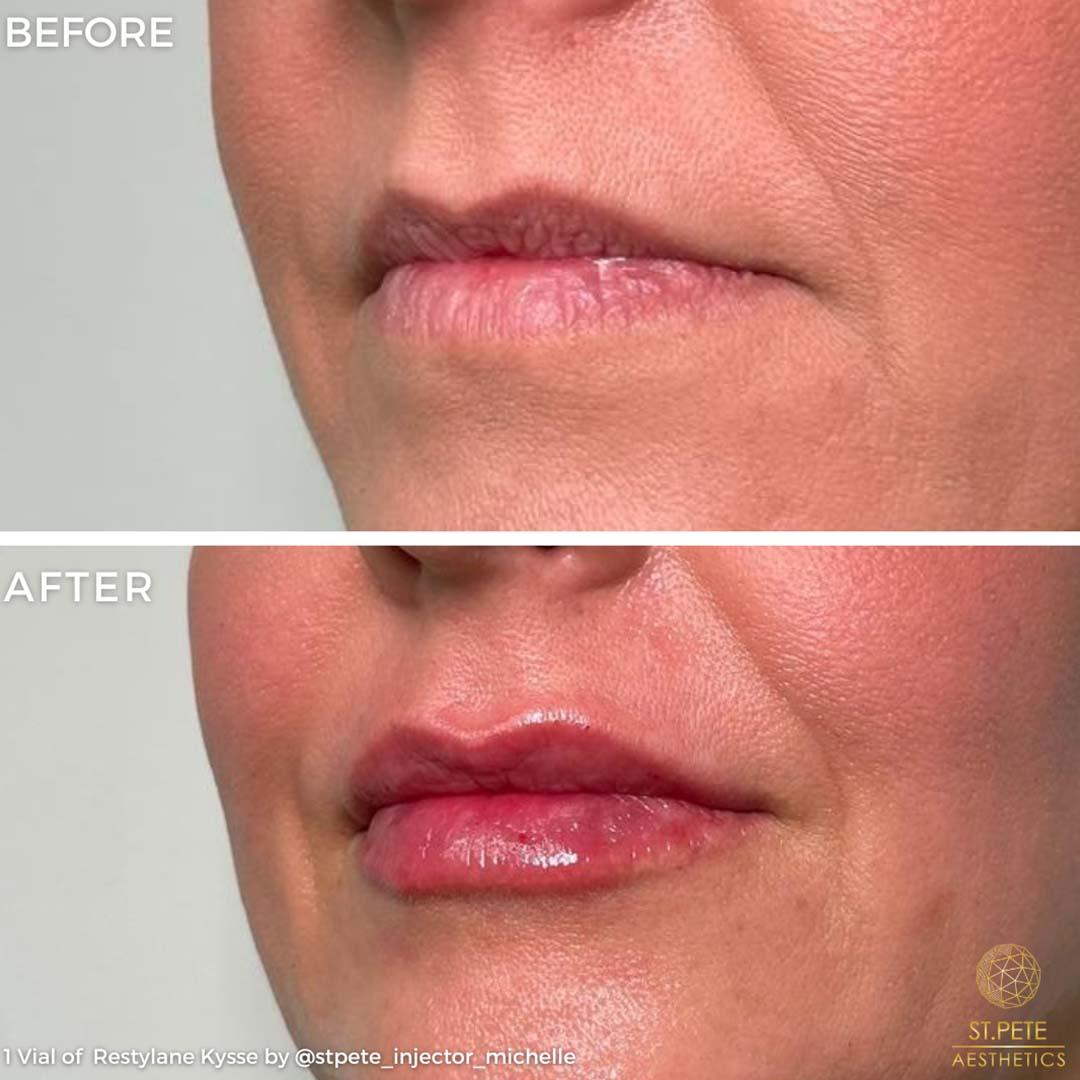 Buffalo Aesthetics | The Medical Spa Experts lip filler result — East Amherst, NY