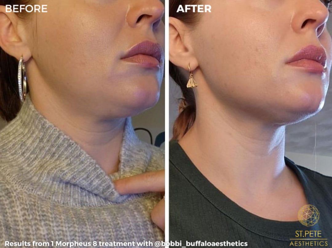 Buffalo Aesthetics | The Medical Spa Experts microneedling result — East Amherst, NY
