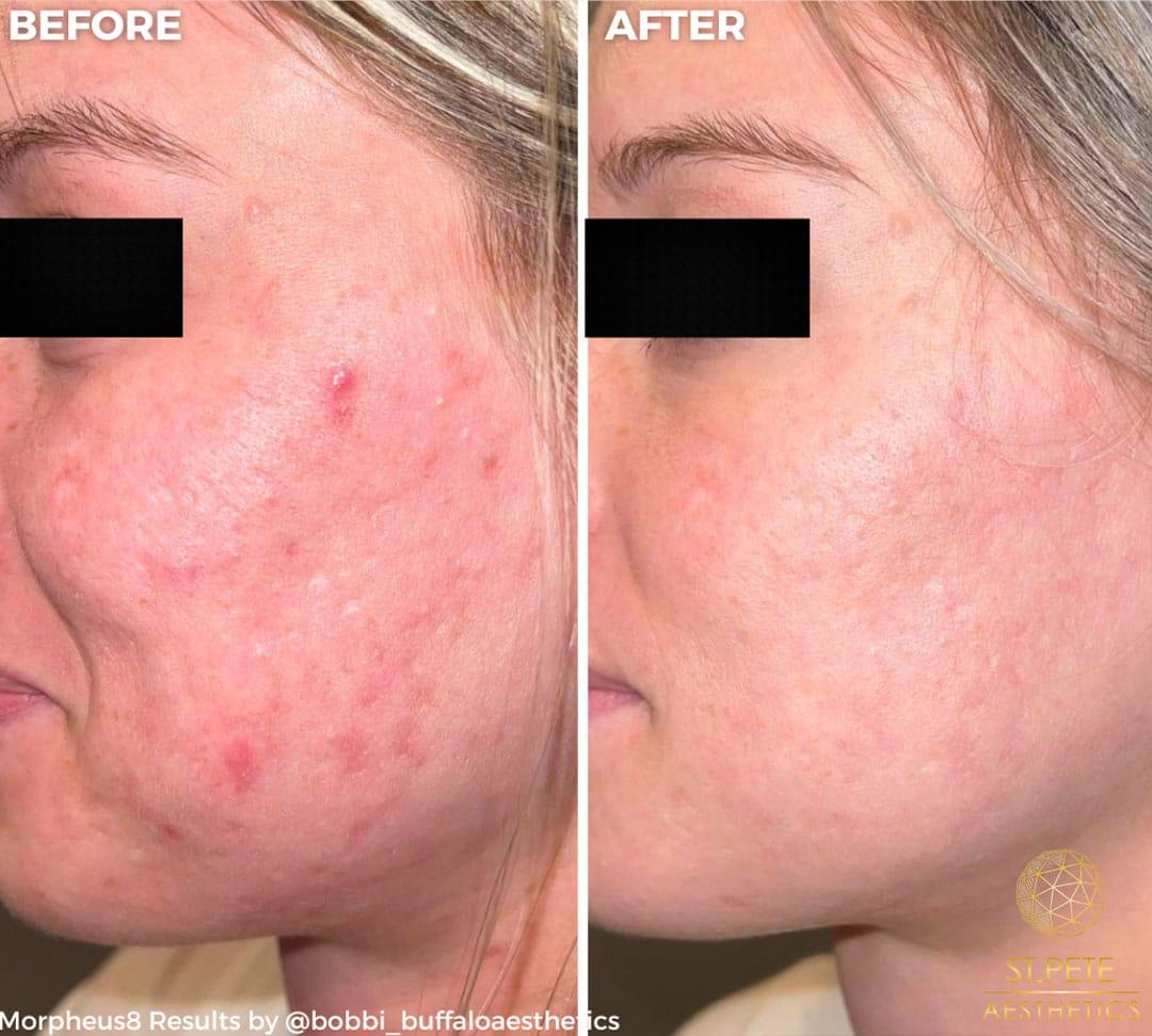 Buffalo Aesthetics | The Medical Spa Experts microneedling result — East Amherst, NY