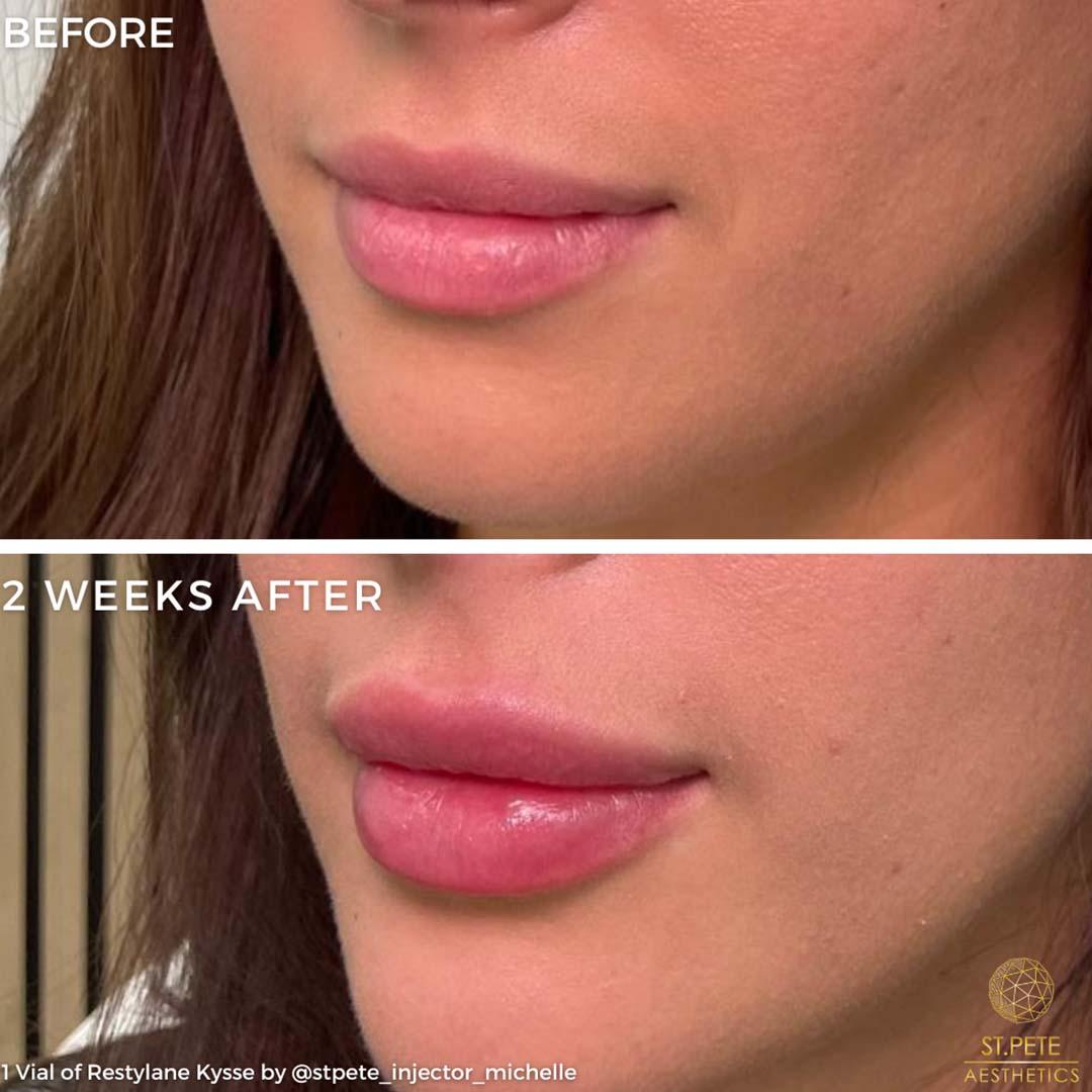 Buffalo Aesthetics | The Medical Spa Experts lip filler result — East Amherst, NY