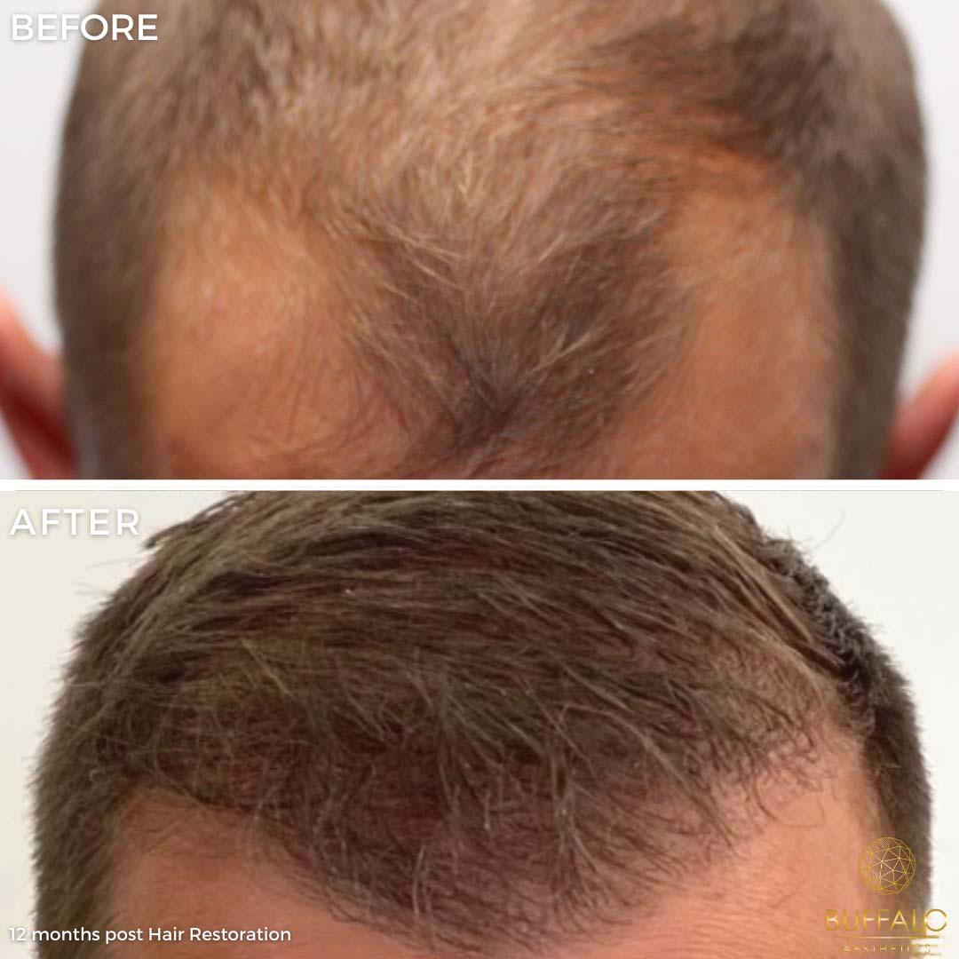 Buffalo Aesthetics | The Medical Spa Experts hair restoration result — East Amherst, NY