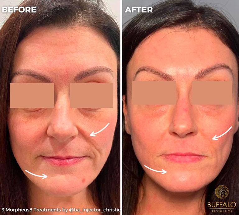 Buffalo Aesthetics | The Medical Spa Experts microneedling after — East Amherst, NY