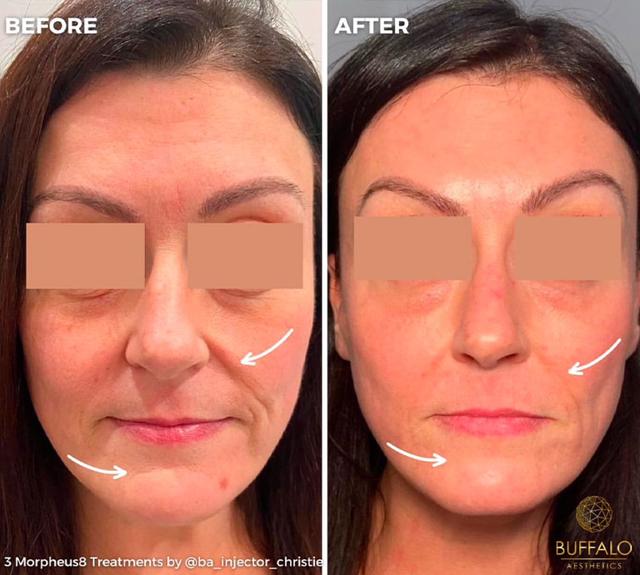 Microneedling after at Buffalo Aesthetics | The Medical Spa Experts in East Amherst, NY