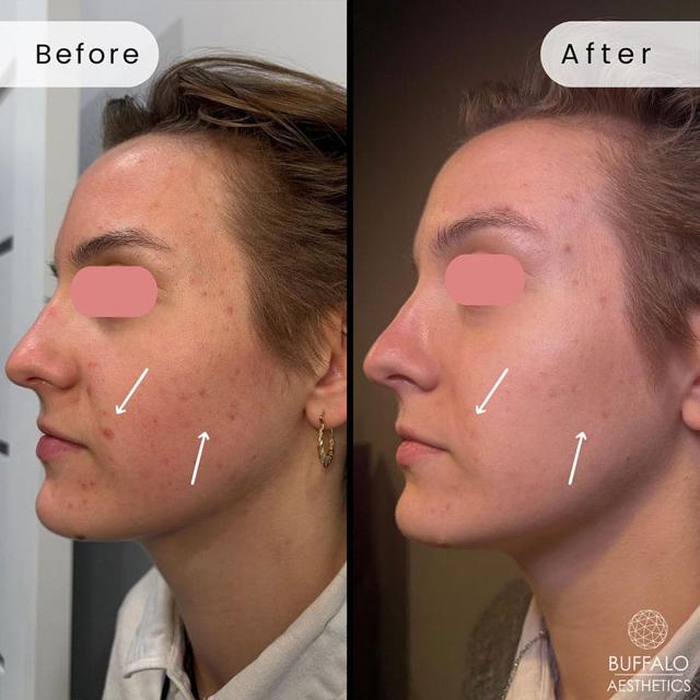 Microneedling result at Buffalo Aesthetics | The Medical Spa Experts in East Amherst, NY