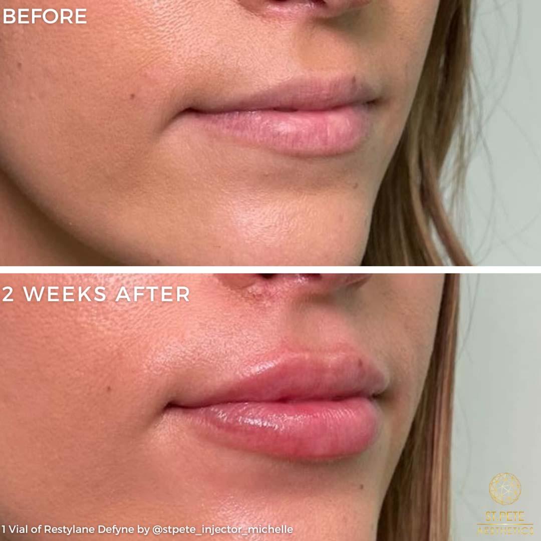 Buffalo Aesthetics | The Medical Spa Experts lip filler result — East Amherst, NY