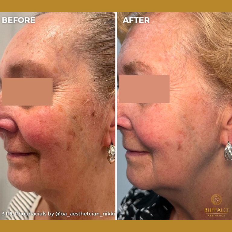 Buffalo Aesthetics | The Medical Spa Experts laser treatment after — East Amherst, NY