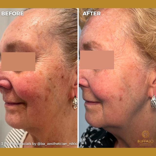 Laser Skin Resurfacing after at Buffalo Aesthetics | The Medical Spa Experts in East Amherst, NY