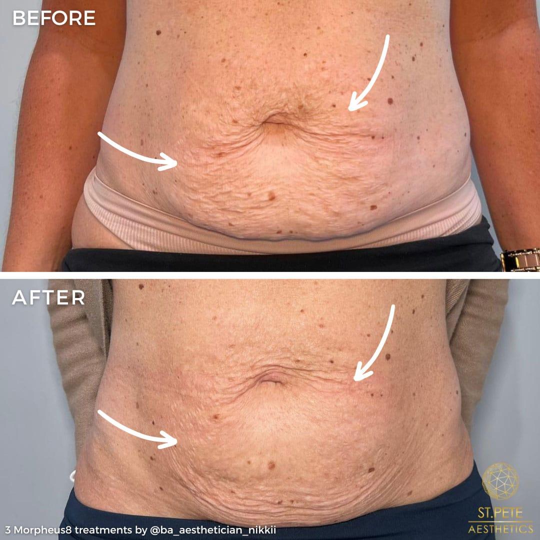 Buffalo Aesthetics | The Medical Spa Experts microneedling result — East Amherst, NY