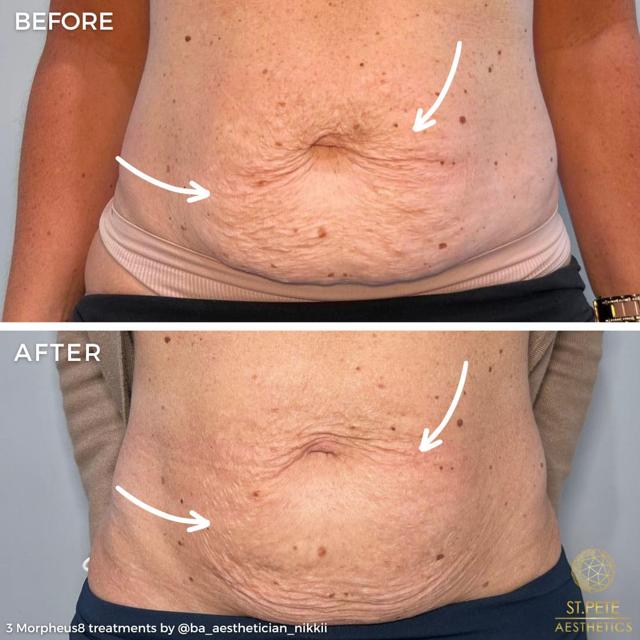 Microneedling result at Buffalo Aesthetics | The Medical Spa Experts in East Amherst, NY