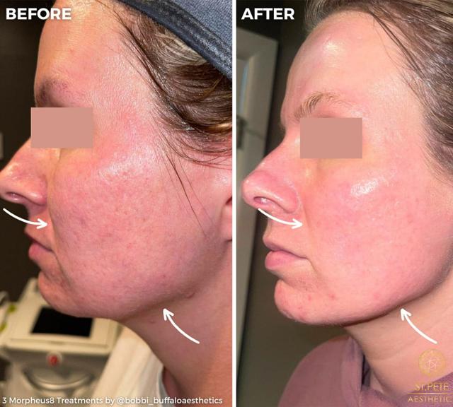 Microneedling result at Buffalo Aesthetics | The Medical Spa Experts in East Amherst, NY