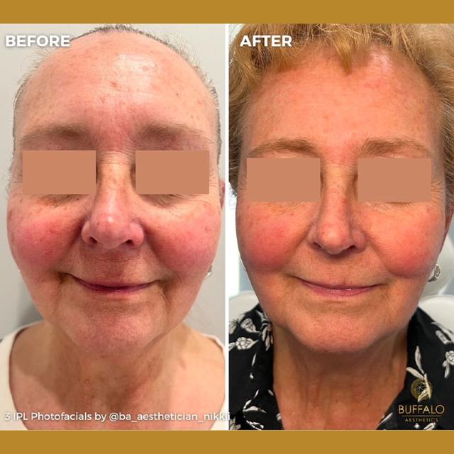 Laser Skin Resurfacing before at Buffalo Aesthetics | The Medical Spa Experts in East Amherst, NY