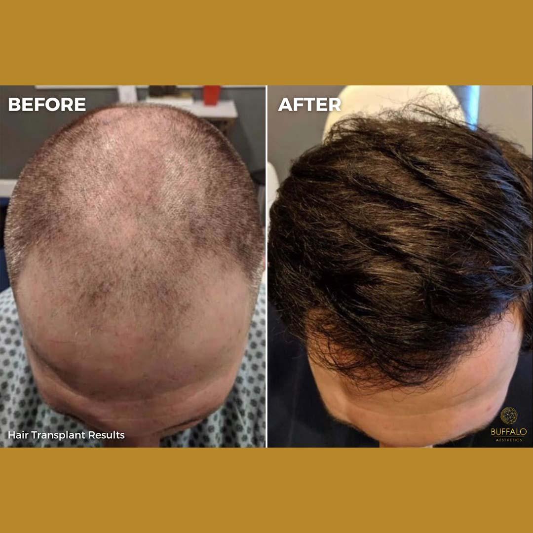 Buffalo Aesthetics | The Medical Spa Experts hair restoration result — East Amherst, NY