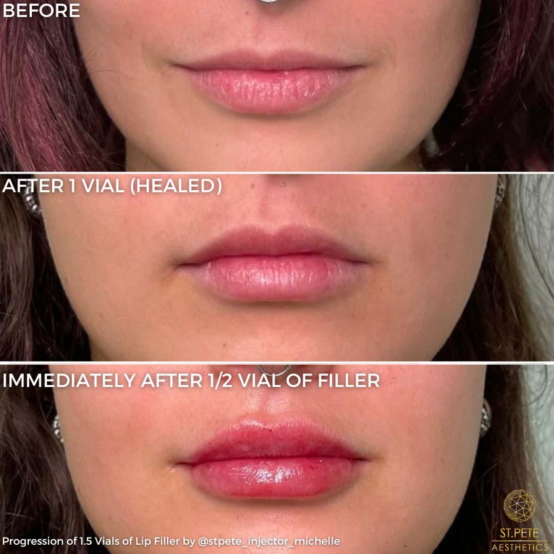 Buffalo Aesthetics | The Medical Spa Experts lip filler result — East Amherst, NY