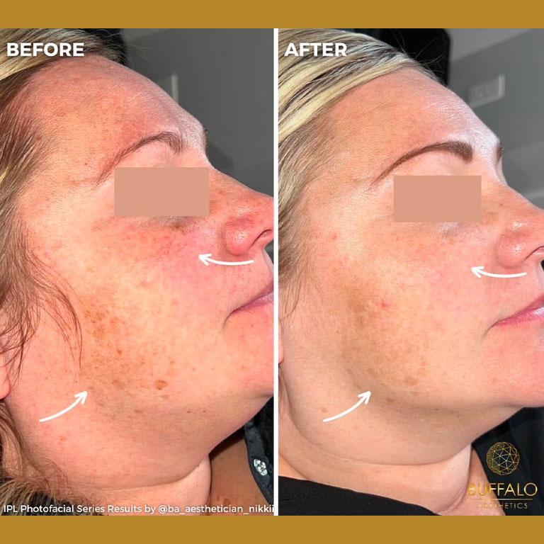 Buffalo Aesthetics | The Medical Spa Experts laser treatment after — East Amherst, NY