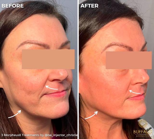 Microneedling before at Buffalo Aesthetics | The Medical Spa Experts in East Amherst, NY