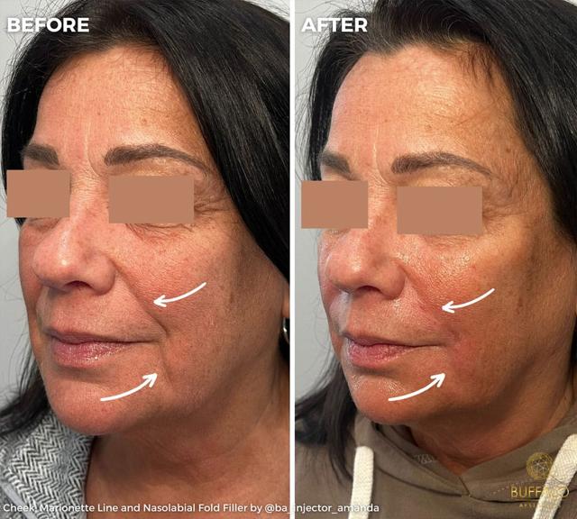 Juvederm result at Buffalo Aesthetics | The Medical Spa Experts in East Amherst, NY