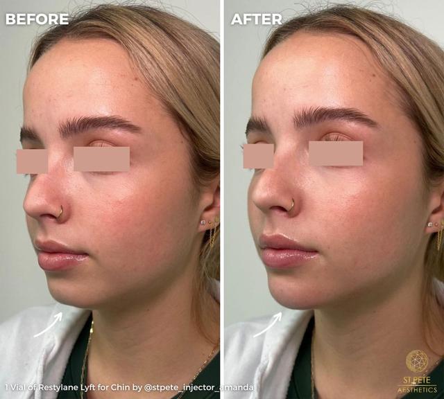 Jawline Filler result at Buffalo Aesthetics | The Medical Spa Experts in East Amherst, NY