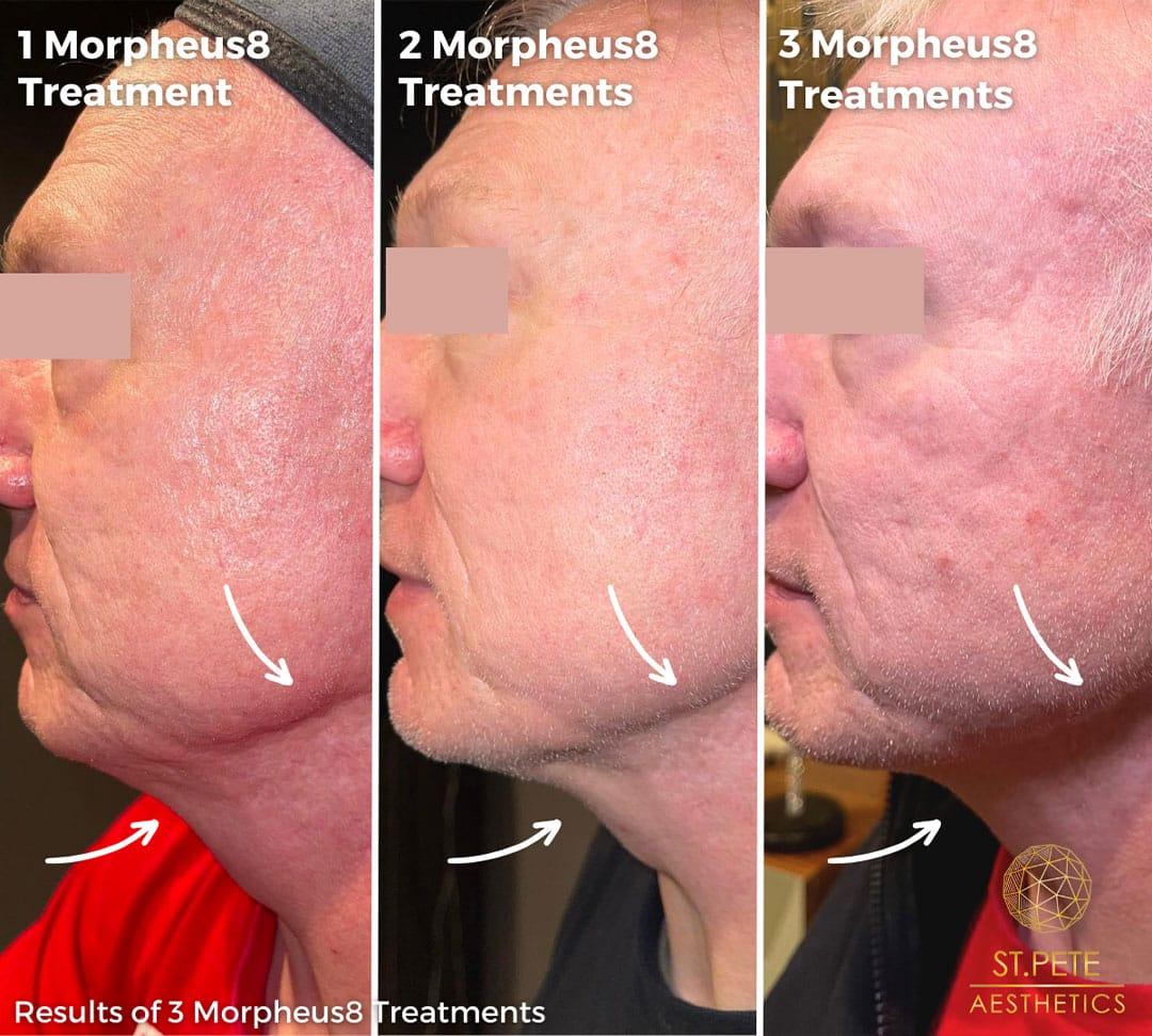 Buffalo Aesthetics | The Medical Spa Experts microneedling result — East Amherst, NY