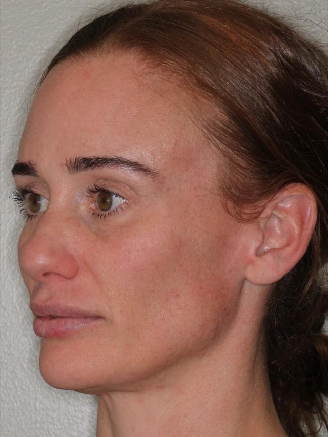 Jawline Filler before at Advanced Dentistry and Aesthetics in Park City, UT