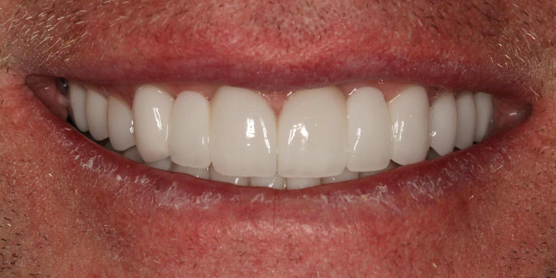 Advanced Dentistry and Aesthetics veneers after — Park City, UT