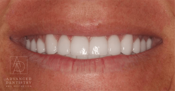 Advanced Dentistry and Aesthetics veneers after — Park City, UT