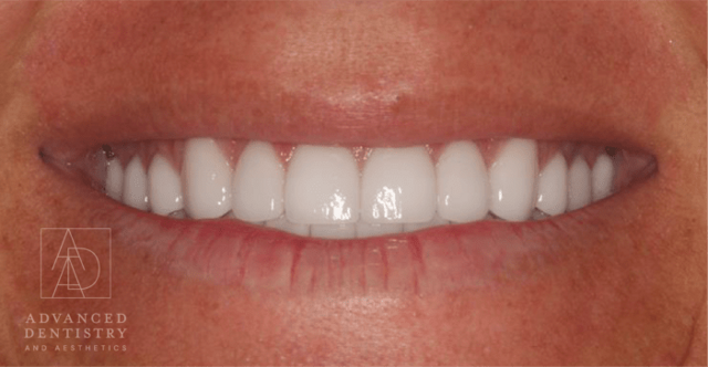 Dental Veneers after at Advanced Dentistry and Aesthetics in Park City, UT