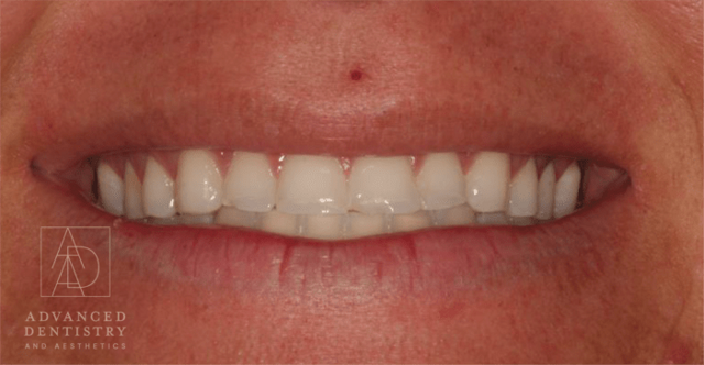 Dental Veneers before at Advanced Dentistry and Aesthetics in Park City, UT