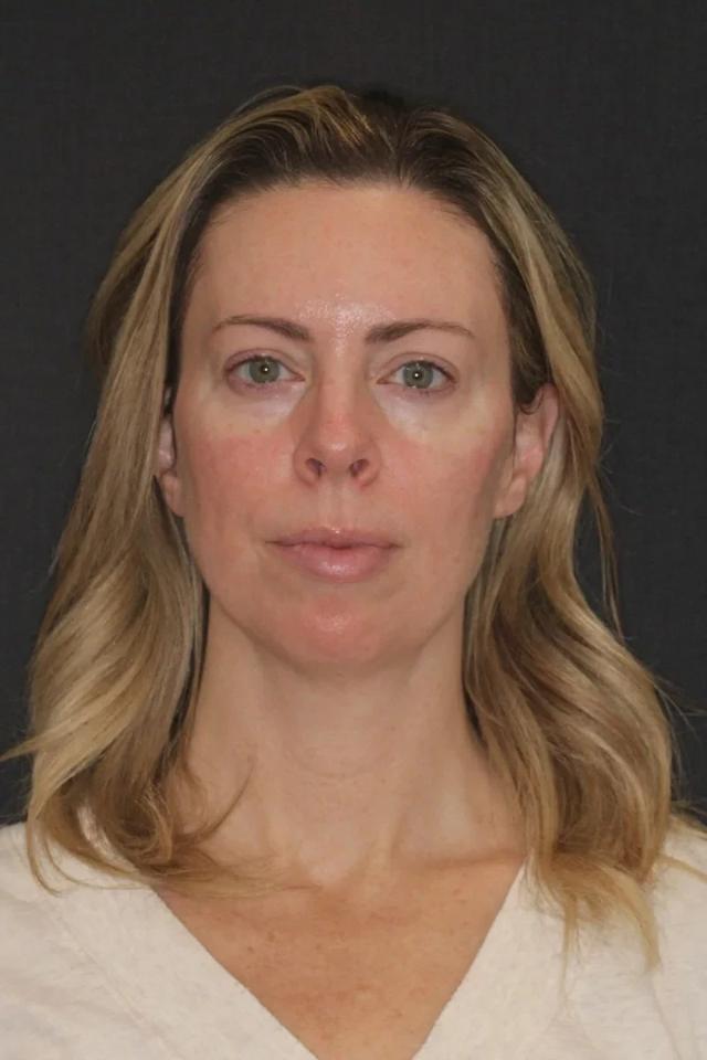 Juvederm after at Advanced Dentistry and Aesthetics in Park City, UT