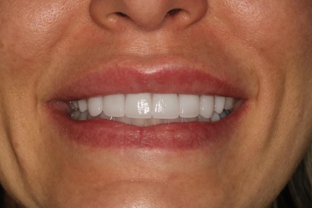 Advanced Dentistry and Aesthetics veneers after — Park City, UT