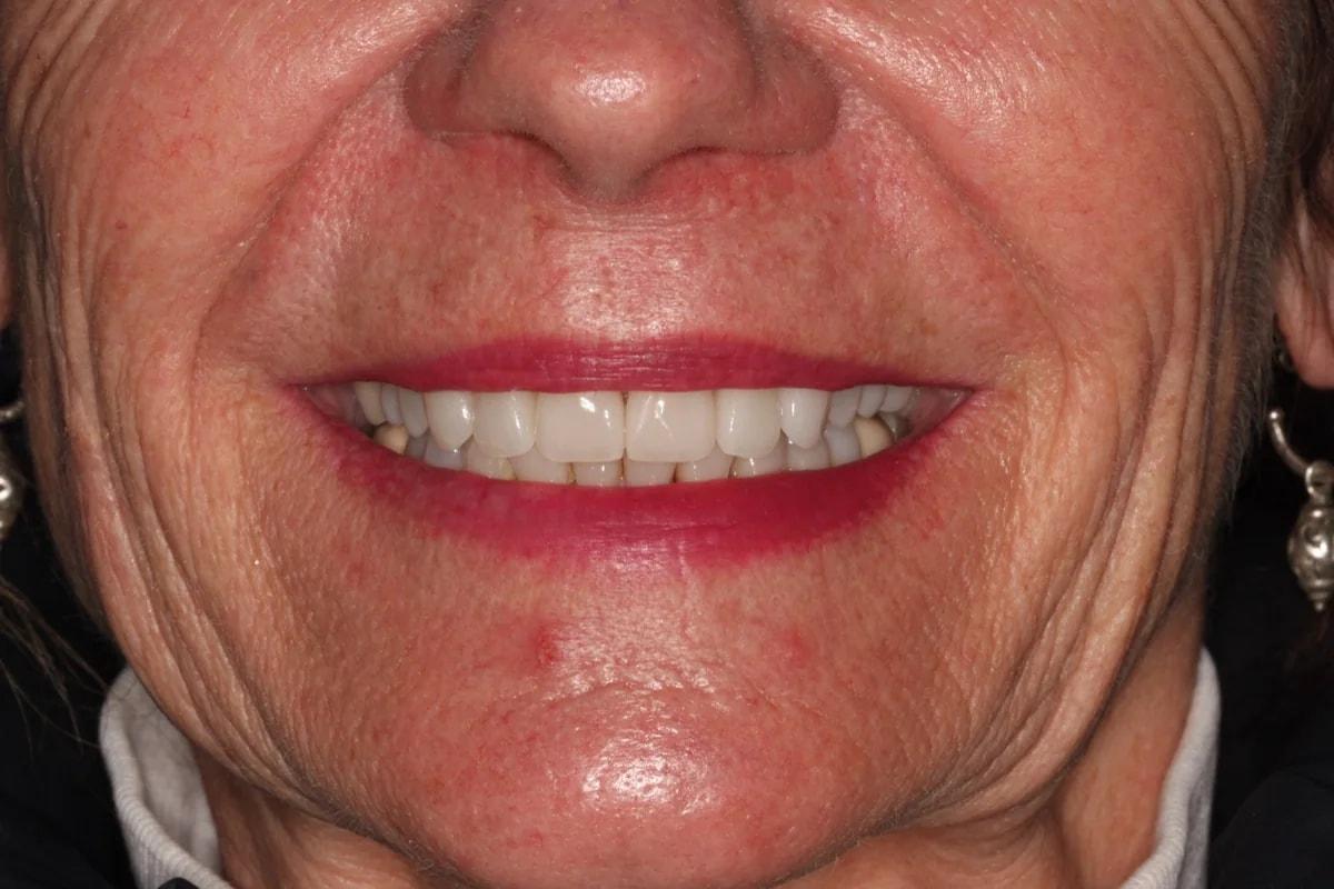 Advanced Dentistry and Aesthetics veneers after — Park City, UT