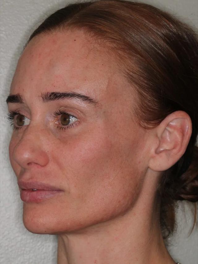 Jawline Filler after at Advanced Dentistry and Aesthetics in Park City, UT
