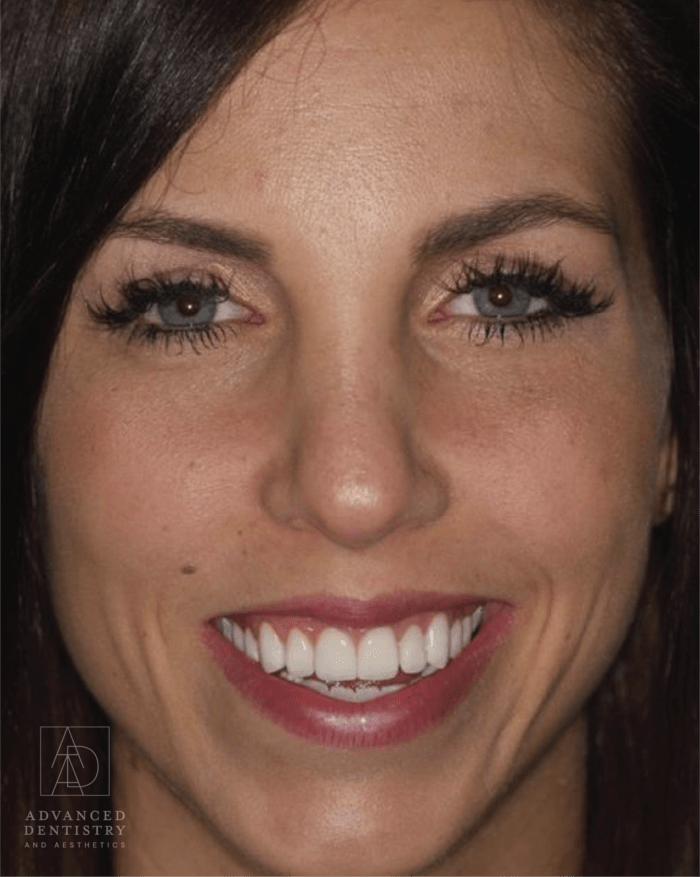 Advanced Dentistry and Aesthetics veneers after — Park City, UT