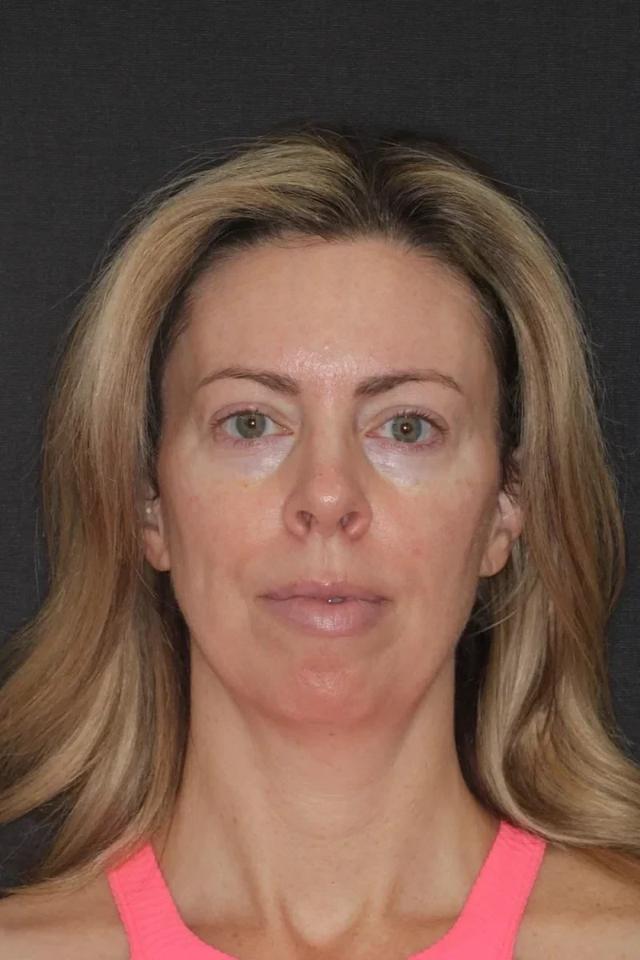 Juvederm before at Advanced Dentistry and Aesthetics in Park City, UT