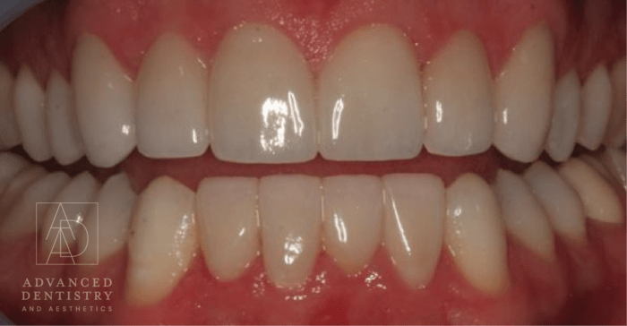 Advanced Dentistry and Aesthetics veneers after — Park City, UT