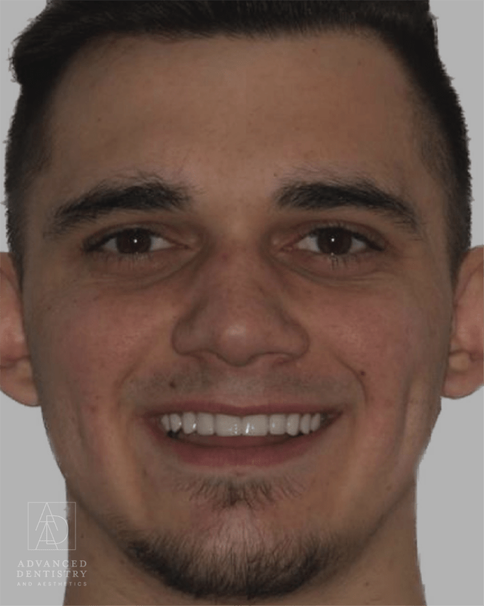 Advanced Dentistry and Aesthetics veneers after — Park City, UT