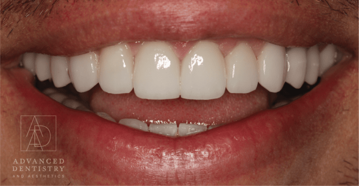 Advanced Dentistry and Aesthetics veneers after — Park City, UT
