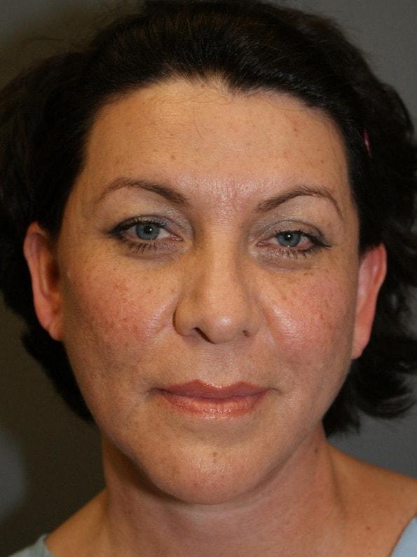 Neck Lift after at DAVinci Plastic Surgery in Washington, DC
