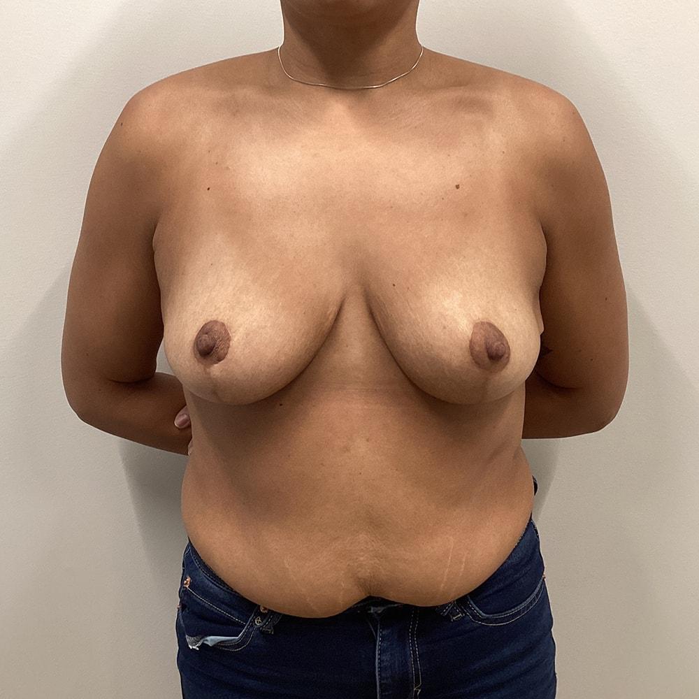 DAVinci Plastic Surgery breast reduction after — Washington, DC