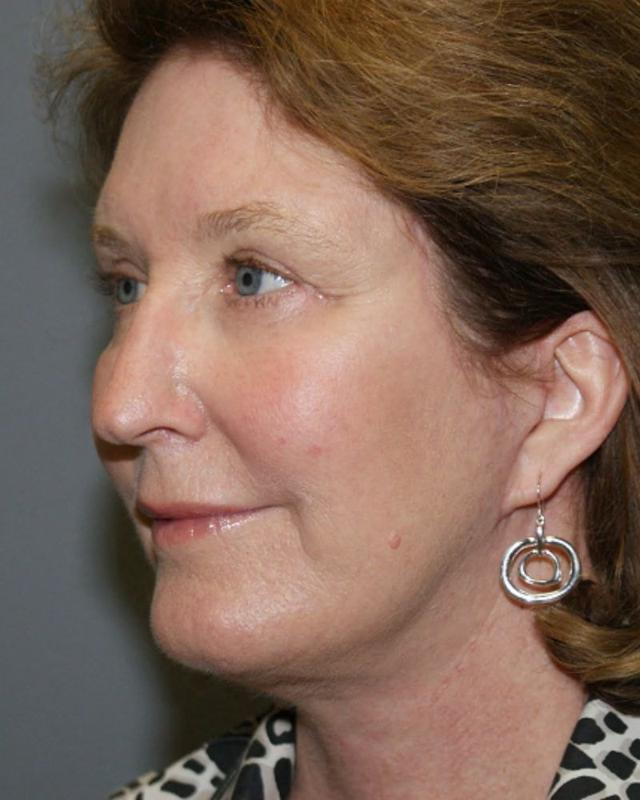 Neck Lift after at DAVinci Plastic Surgery in Washington, DC